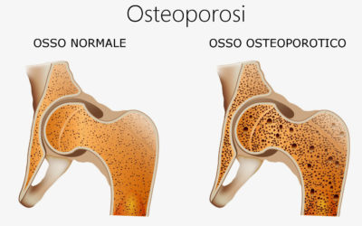 L’OSTEOPOROSI