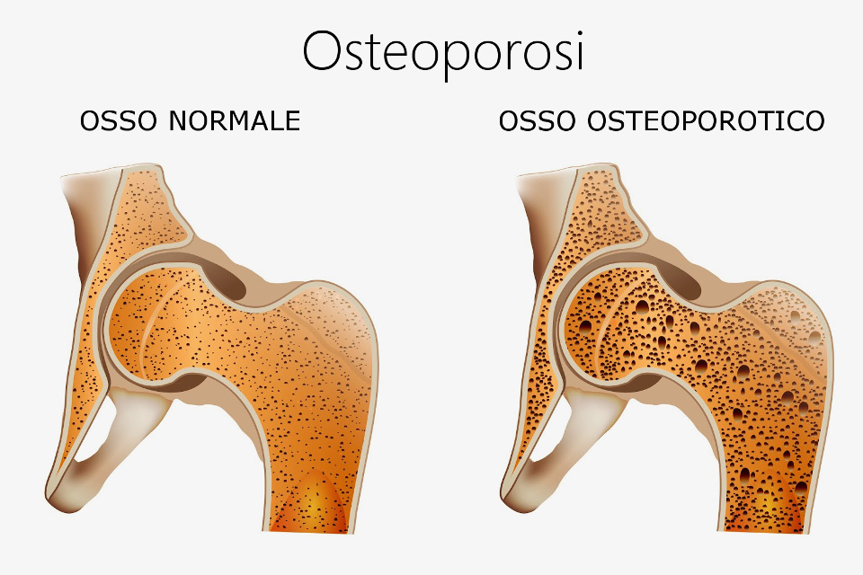 L’OSTEOPOROSI